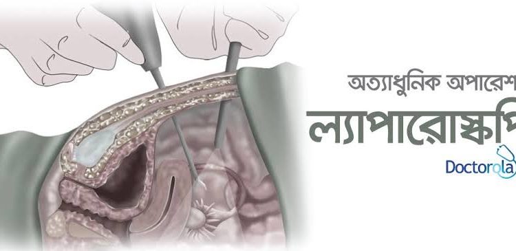 ল্যাপারোস্কপির মাধ্যমে খাদ্যনালীর ক্যান্সারে সফল অস্ত্রোপচার